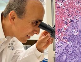 On the left, lung cancer expert Hamid Mirshahidi, MD, peers into a microscope; on the right is an image of what a type of lung cancer looks like on the microscopic level.
