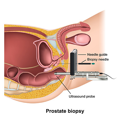 Prostate biopsy