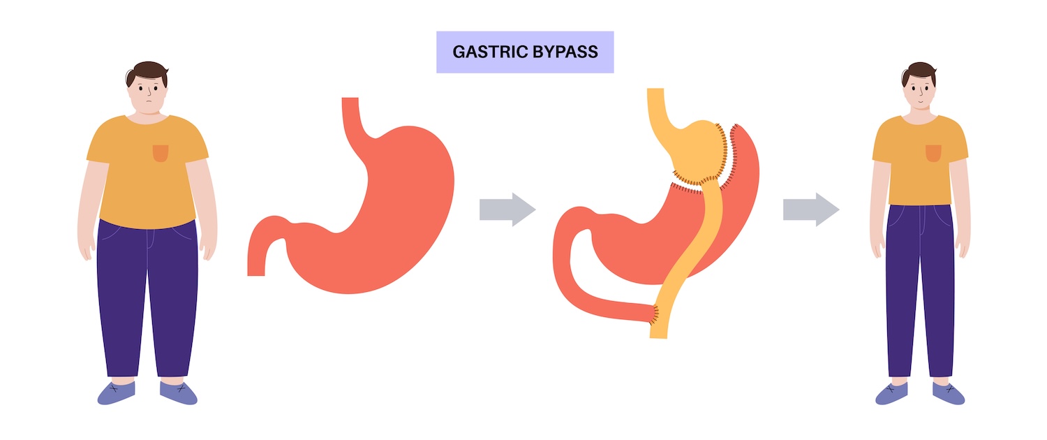 Male body before and after stomach gastric bypass gastroplasty operation. 