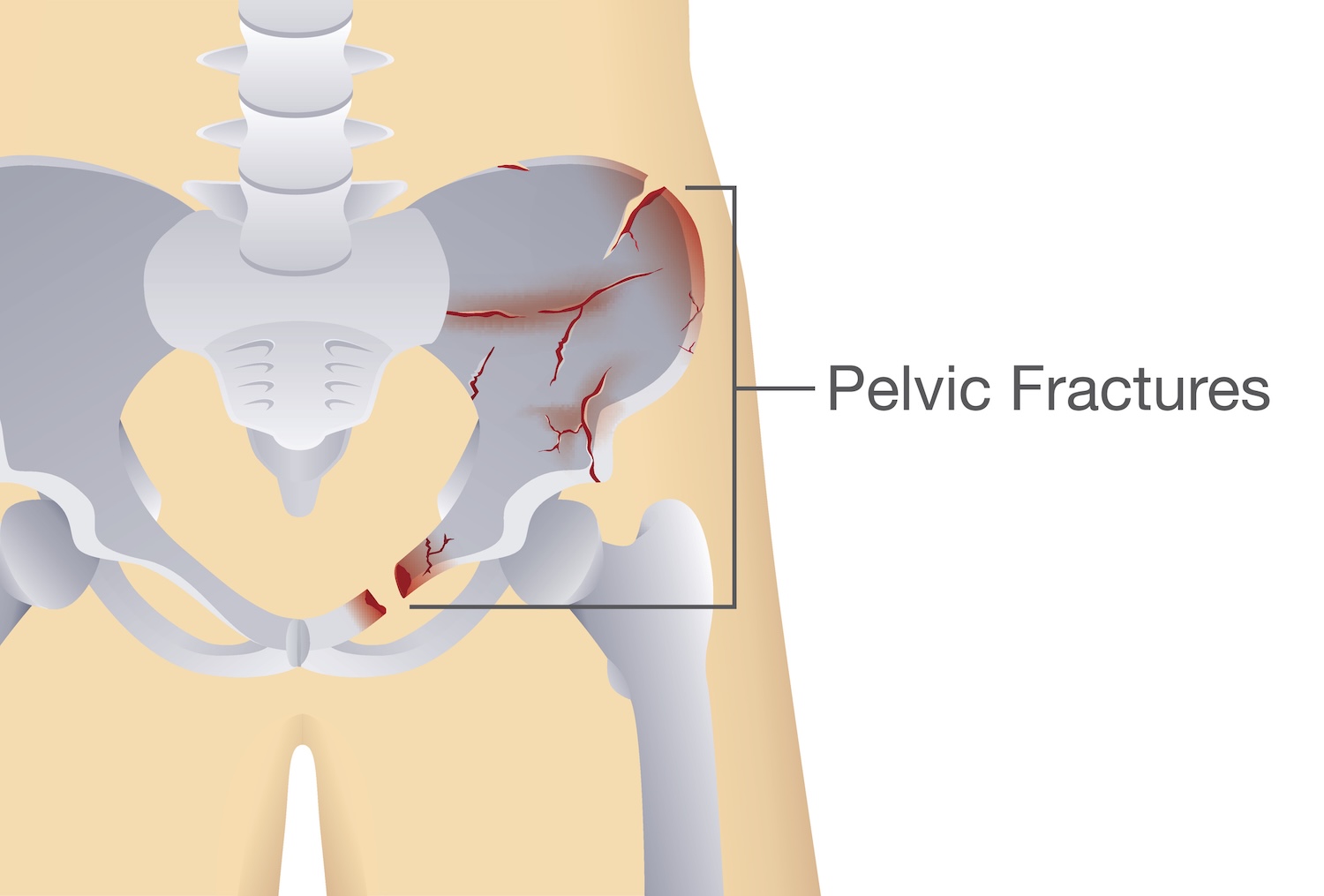 Graphic of fractures of the pelvic