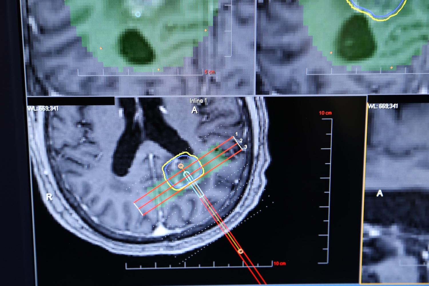 Brain scans on a computer screen