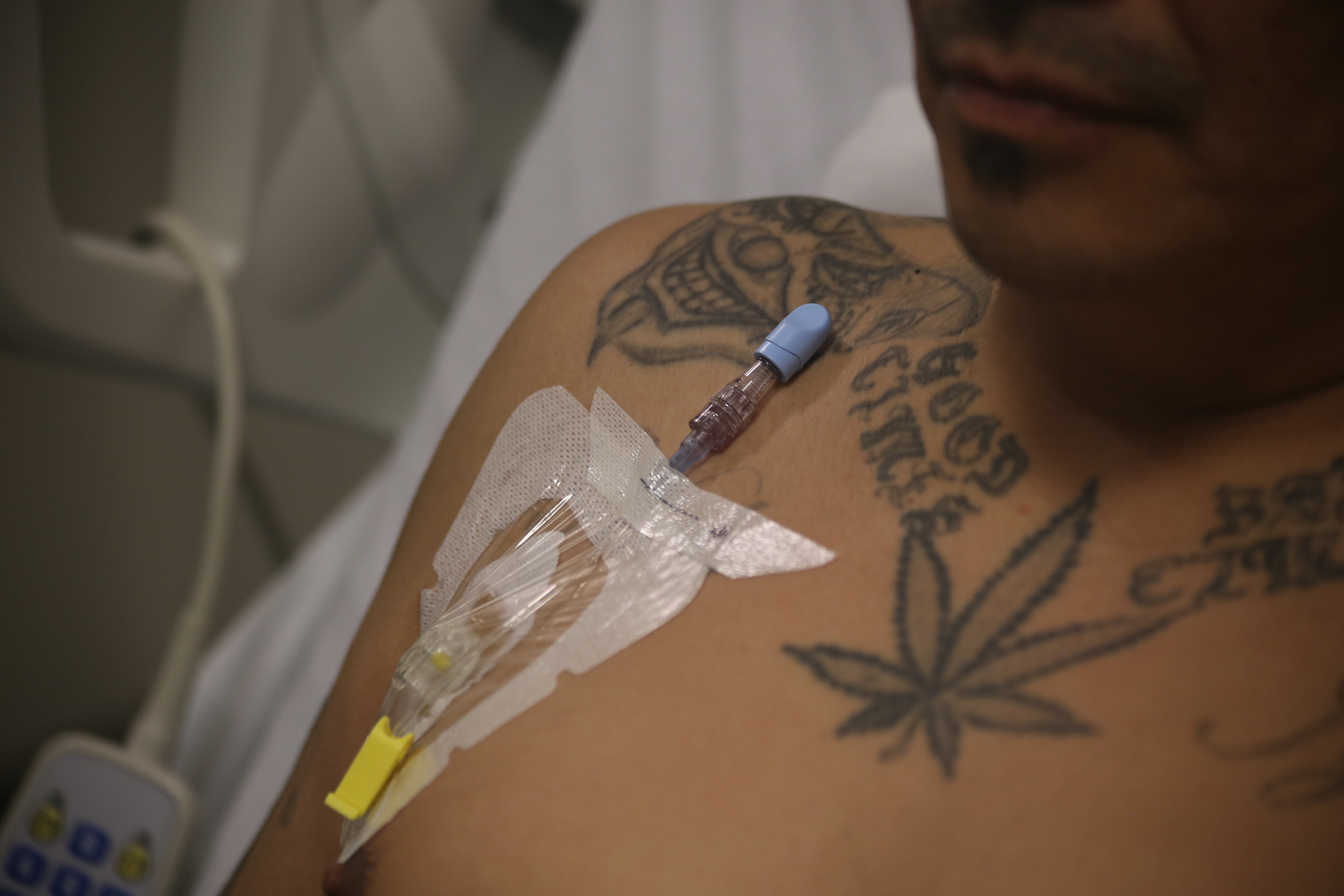 a close up of a systemic chemotherapy port on a man