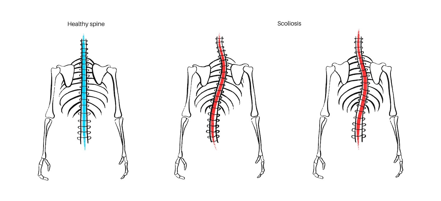  Scoliosis spine deformity - stock illustration Healthy spine, combined and thoracic scoliosis in the human body. Spine anatomy concept, dorsal posture conditions. Spinal deformities and curvature types vector illustration, vertebra medical diagram