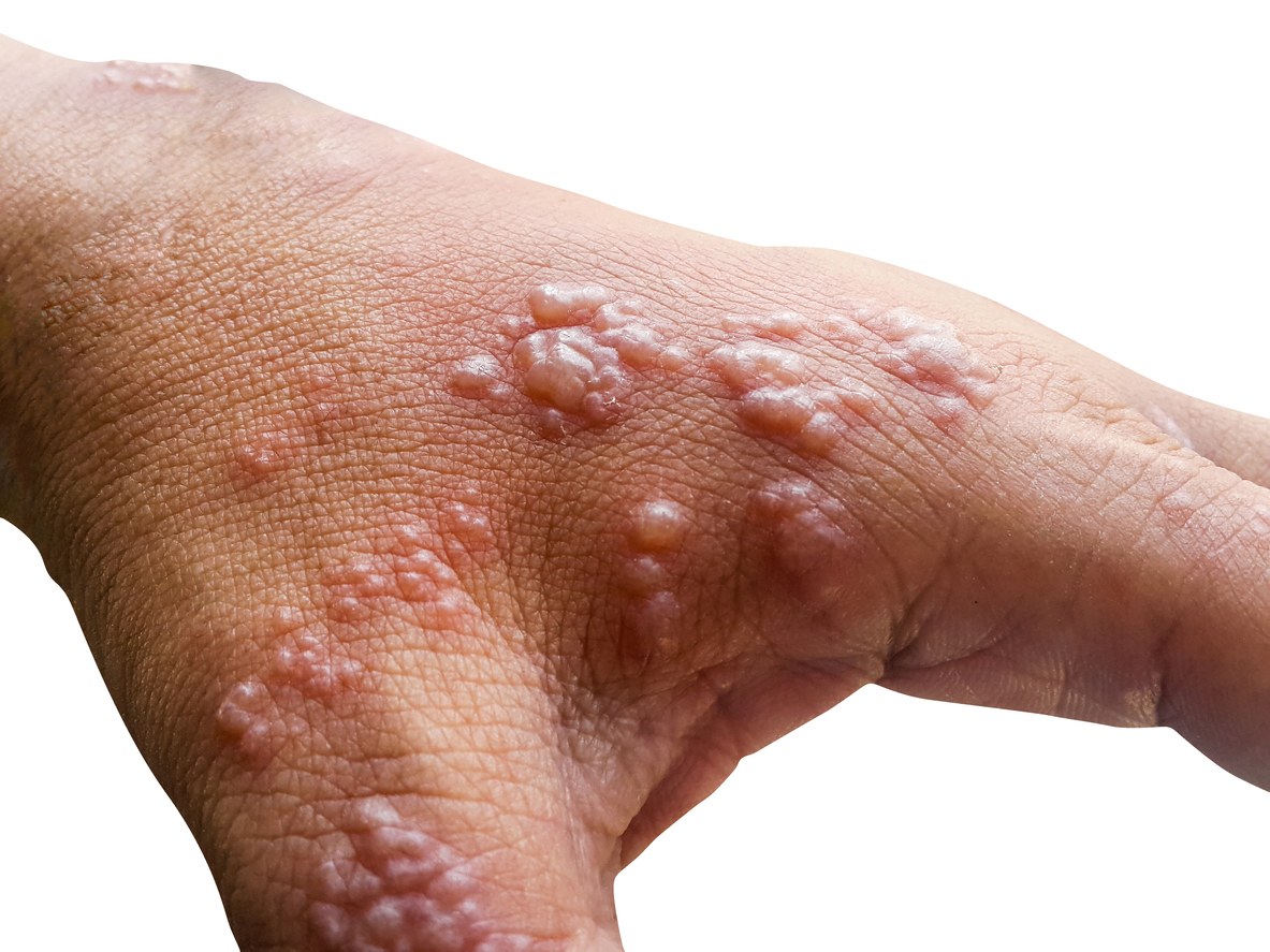 the kin lesions associated with mallpox emt