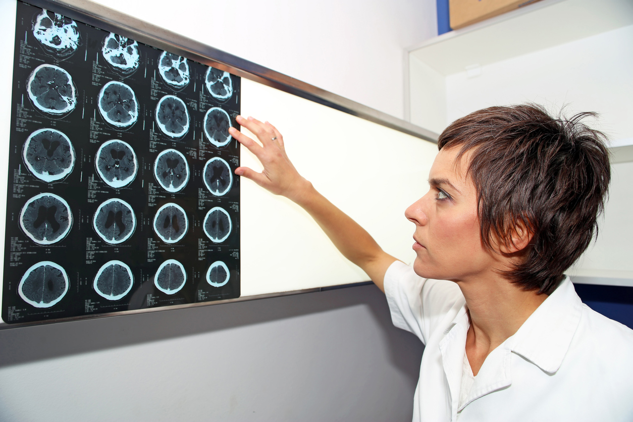 Do strokes affect women differently? News