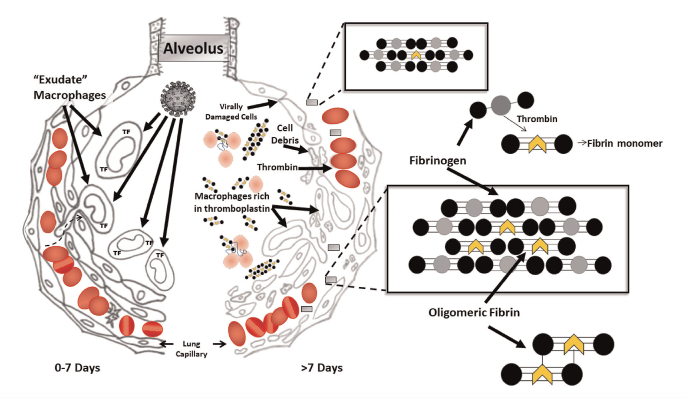 Study identifies micro clots as cause of death in some severely ill  COVID-19 patients