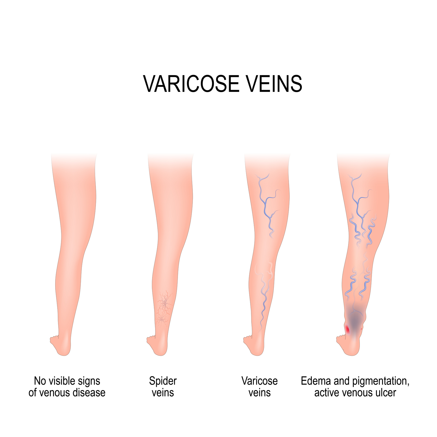 Varicose Veins: Cosmetic concern or health risk