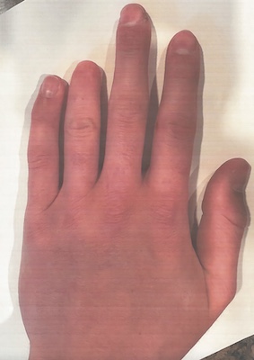 Tanners hand at 18. Short ring and pinky fingers