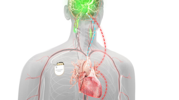 graphic illustration of baroflex therapy
