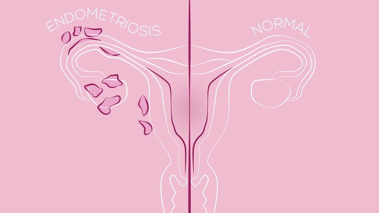 Illustration of endometriosis