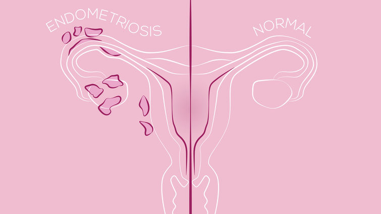 Period Pain: Could It Be Endometriosis?