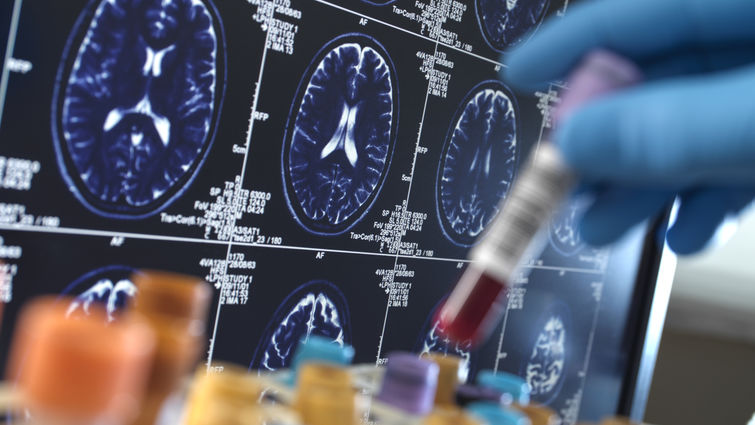 Scientist holding a blood sample during a clinical trial with a MRI on screen - stock photo