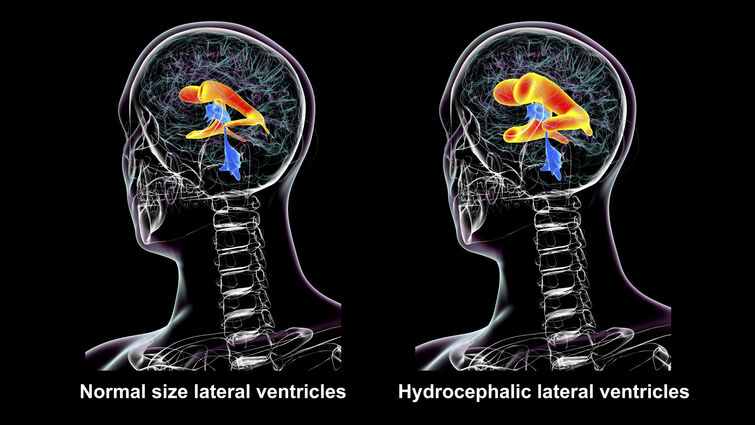 If caught early, NPH is the only treatable form of dementia Image of two brains with one image representing normal levels and the other has elevated levels