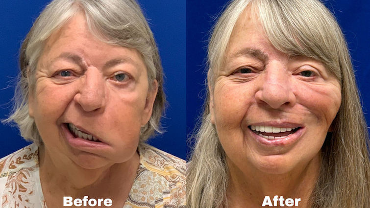 Before and after photos of caucasian woman with gray hair smiling