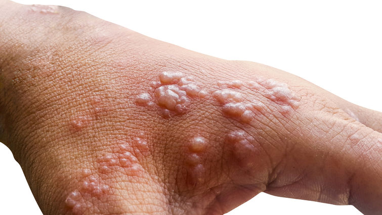 Got rashes? How do you know it's Monkeypox, not something else?