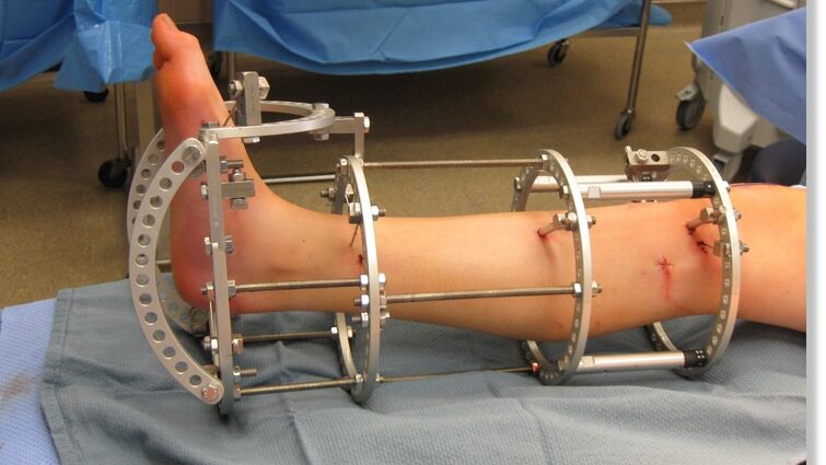 A metal device called an external fixator is wrapped around a leg in a surgery room as it sits on a table