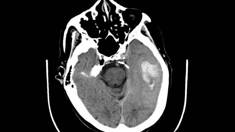 This is the CT scan of an elderly person who suddenly developed difficulties speaking. It shows bleeding in the left temporal lobe. Further testing revealed a clot in one of the veins of the brain (intracranial vein thrombosis). A black and white CT scan of a brain that shows a spot in the brain where a blood clot developed