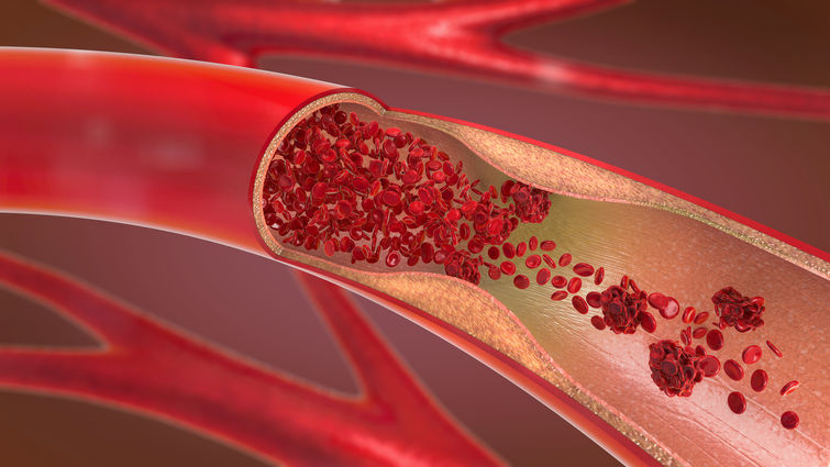 an artery with cholestoral