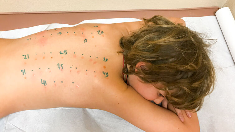 Child lays in a doctor's office while getting tested for allergies on his back.