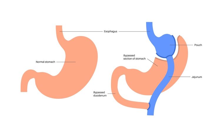 Gastric bypass gastroplasty stomach operation. Human organs before and after surgery.