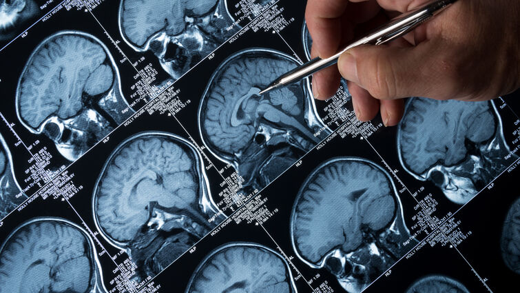 Epilepsy