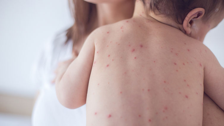 Measles Measles