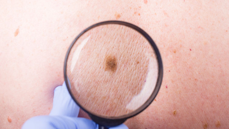 Microscope on a skin mole