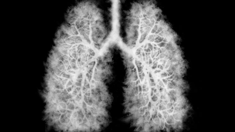 smokey lung photo
