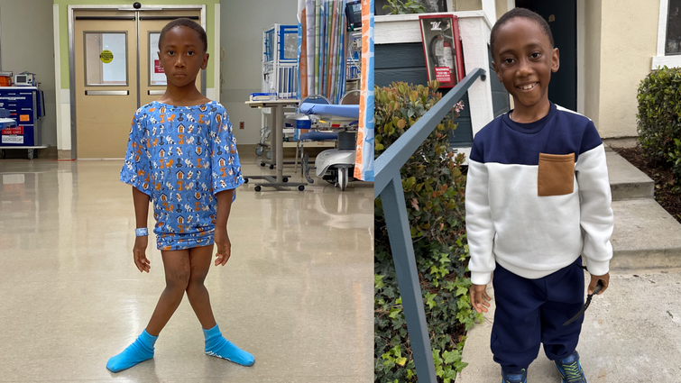 Two photos, first photo of a young boy standing in a hospital with knocked knees, second photo, same boy smiling at the camera with straight knees
