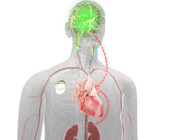 graphic illustration of baroflex therapy