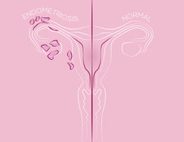 Illustration of endometriosis