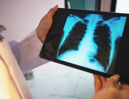 A doctor looking at an X-ray of the lungs