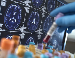  Scientist holding a blood sample during a clinical trial with a MRI on screen - stock photo