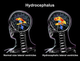 Image of two brains with one image representing normal levels and the other has elevated levels