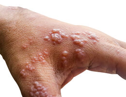 Early symptoms of monkeypox will be followed by a rash of fluid-filled blisters in one to three days. 