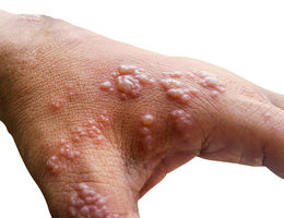 Early symptoms of monkeypox will be followed by a rash of fluid-filled blisters in one to three days. 
