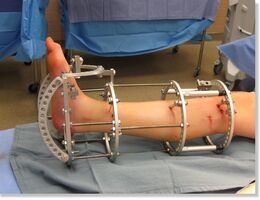 A metal device called an external fixator is wrapped around a leg in a surgery room as it sits on a table