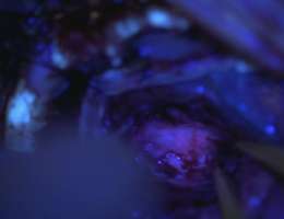 This photo shows the fluorescent features in gliomas under blue light of fluorescent-guided neurosurgery in a procedure performed by Dr. Tarek El Ahmadieh.
