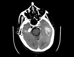 A black and white CT scan of a brain that shows a spot in the brain where a blood clot developed