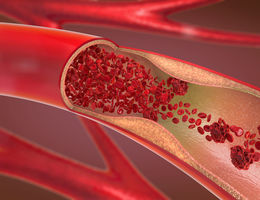 an artery with cholestoral