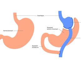 Gastric bypass gastroplasty stomach operation. Human organs before and after surgery.