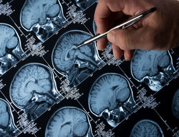 MRI Brain Scan of head and skull with hand pointing stock photo