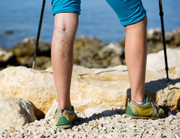 Person with varicose veins on a summer hike