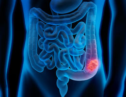 Graphic of a growth in the colon