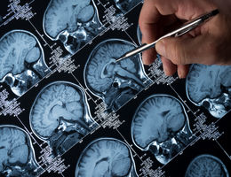 Epilepsy Epilepsy