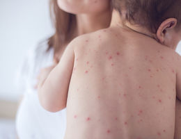 Measles 