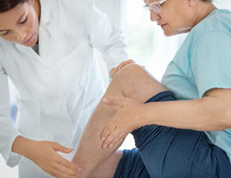 Varicose Veins