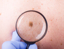 Microscope on a skin mole