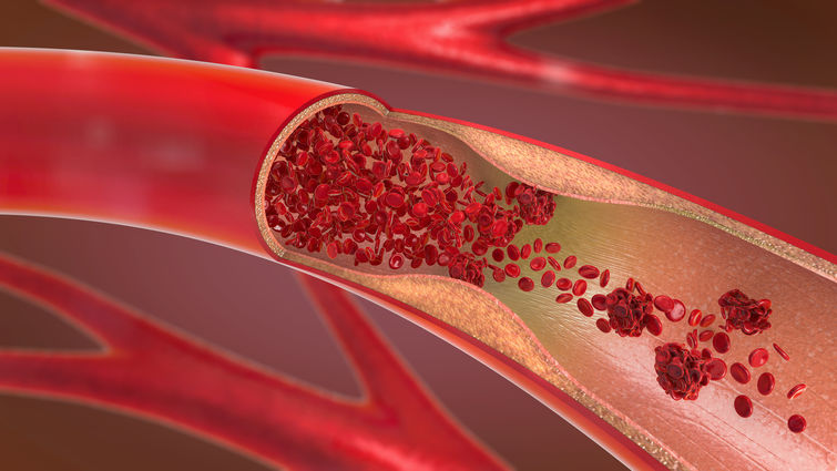 Wallpaper The Abc S Of Coronary Artery Disease Lluh News Desktop Wallpaper