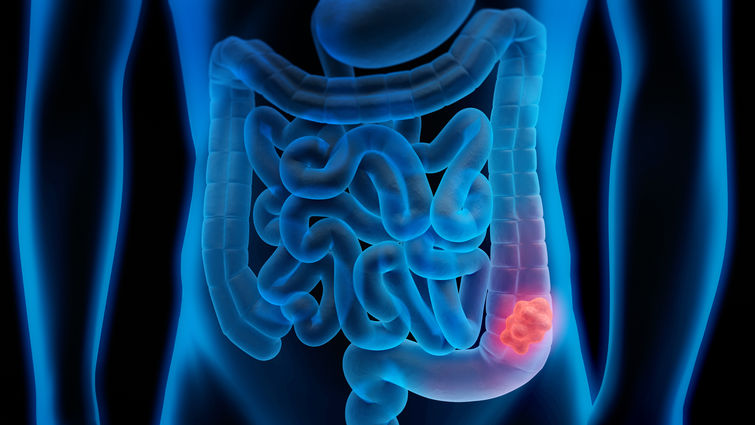 Graphic of a growth in the colon